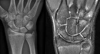 MRI met meerdere zones van beenmergoedeem, passend bij spongiosafracturen in de carpalen en metacarpalen