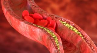 Aderverkalking als gevolg van diabetes leidt tot hartproblemen