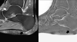 beeld van fasciitis plantaris en hielspoor: links toont de sagittale T2-gewogen opname met vetonderdrukking een verdikte proximale fascia plantaris, een verhoogd T2-signaal met aanliggend wekedelen- en beenmergoedeem
