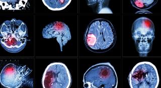 Dienst neurologie - CVA