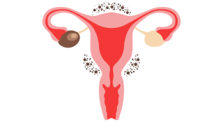 Endometriose - diagnose